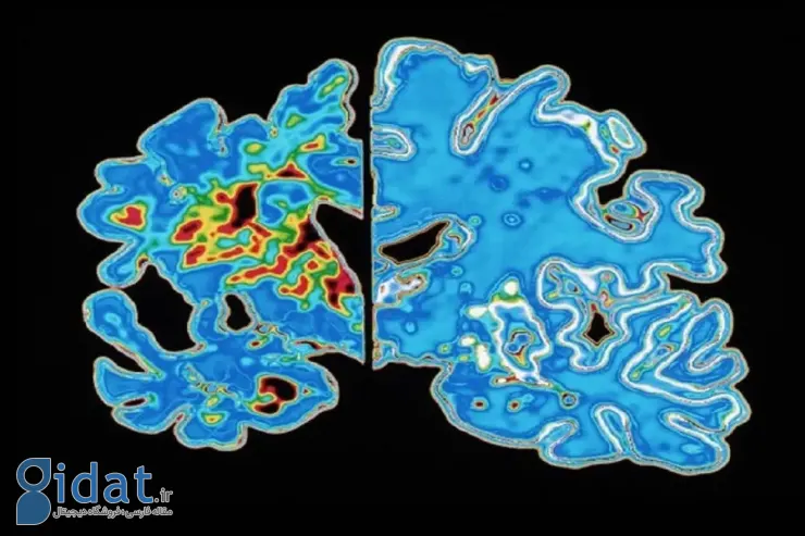 دانشمندان «ساعت آلزایمر» ساختند!