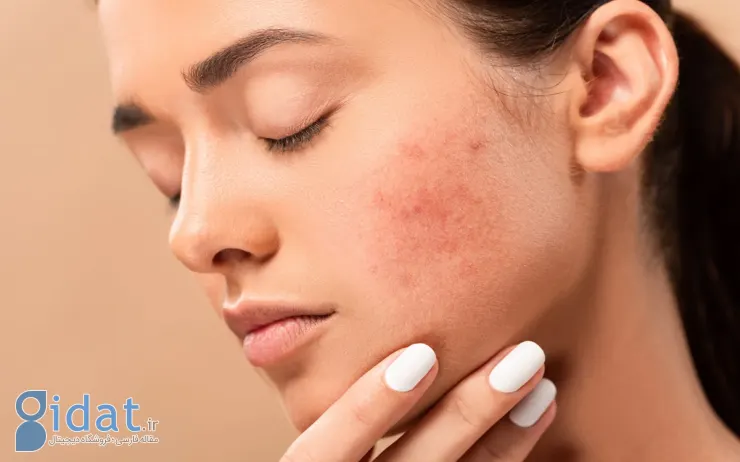 acne-scar-best-home-remedies