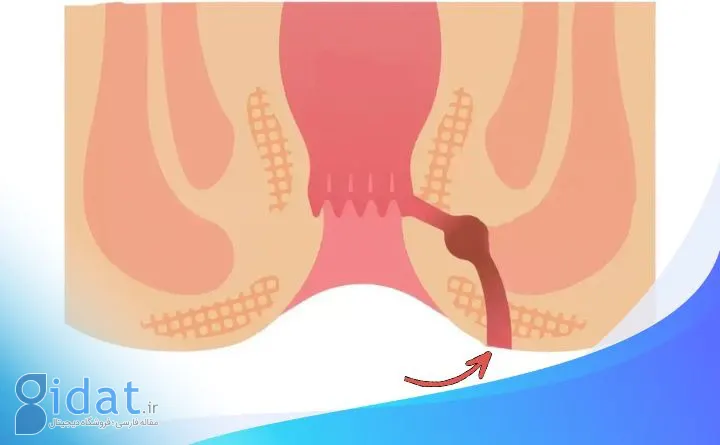 آیا فیستول مقعدی خطرناک است؟