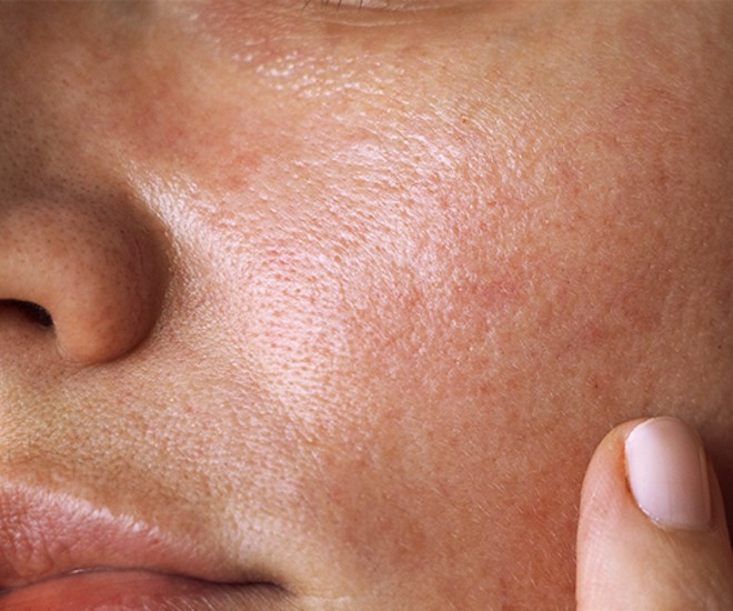 علت براق شدن پوست بینی بعد از عمل