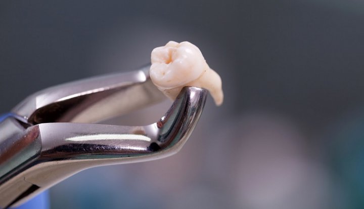 مراقبت های بعد از کشیدن دندان؛ بعد از جراحی یا کشیدن دندان چه باید کرد؟