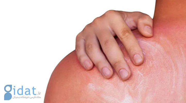 آفتاب سوختگی و خارش سینه