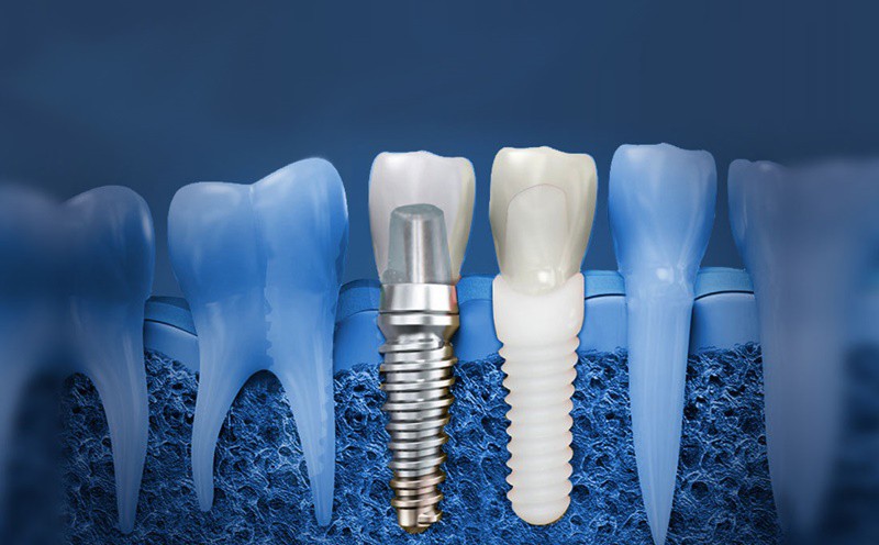 متخصص ایمپلنت دندان کیست و چه کاری انجام می‌دهد؟
