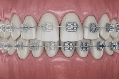 ارتودنسی دندان و عوامل موثر بر قیمت