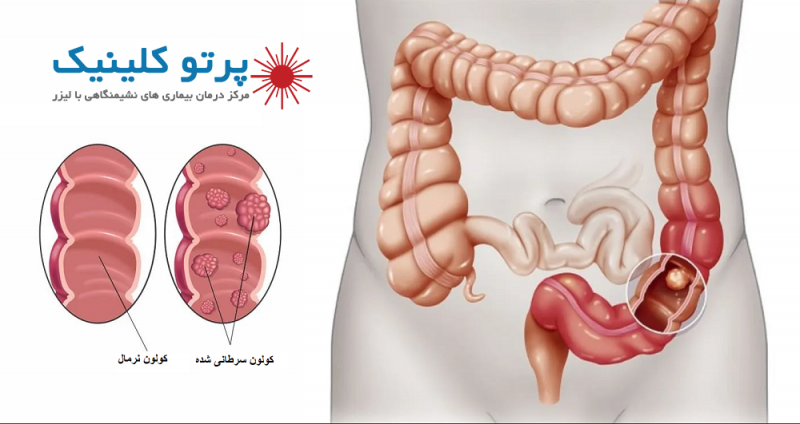 هشدار! مدفوع سیاه و خون آلود: ۲ زنگ خطر مهم برای سرطان