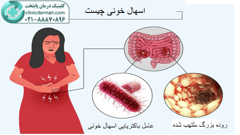 آیا اسهال خونی خطرناک است