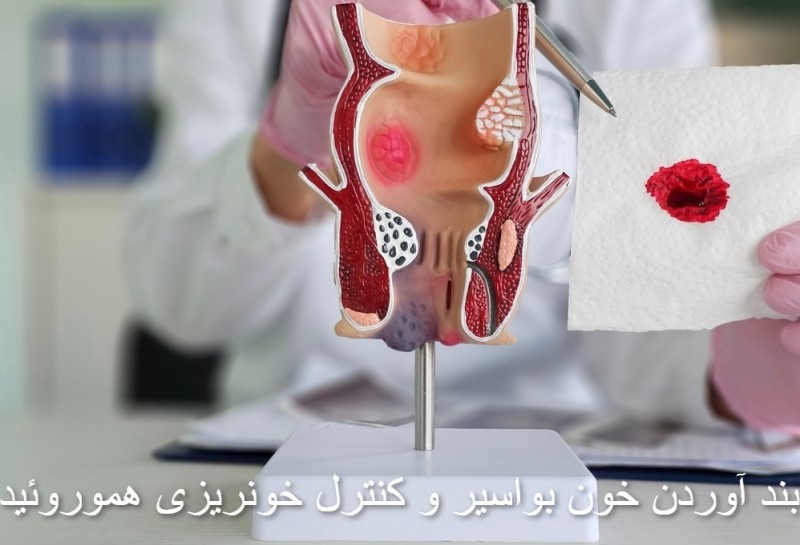 بواسیر خونی چگونه درمان می‌شود؟ بررسی راهکارهای پزشکی