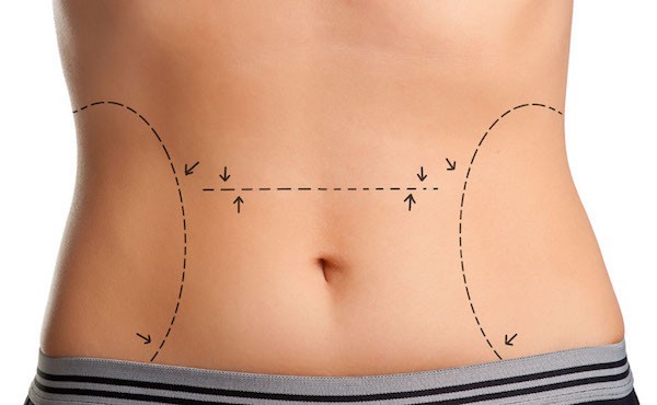 کوچک کردن شکم با جراحی ابدومینوپلاستی